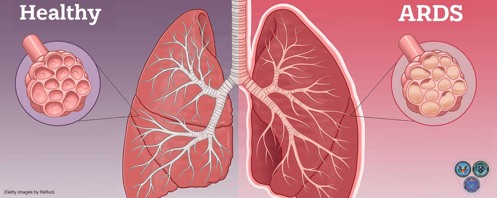 JSTO In The News Article on Respiratory Reinforcements